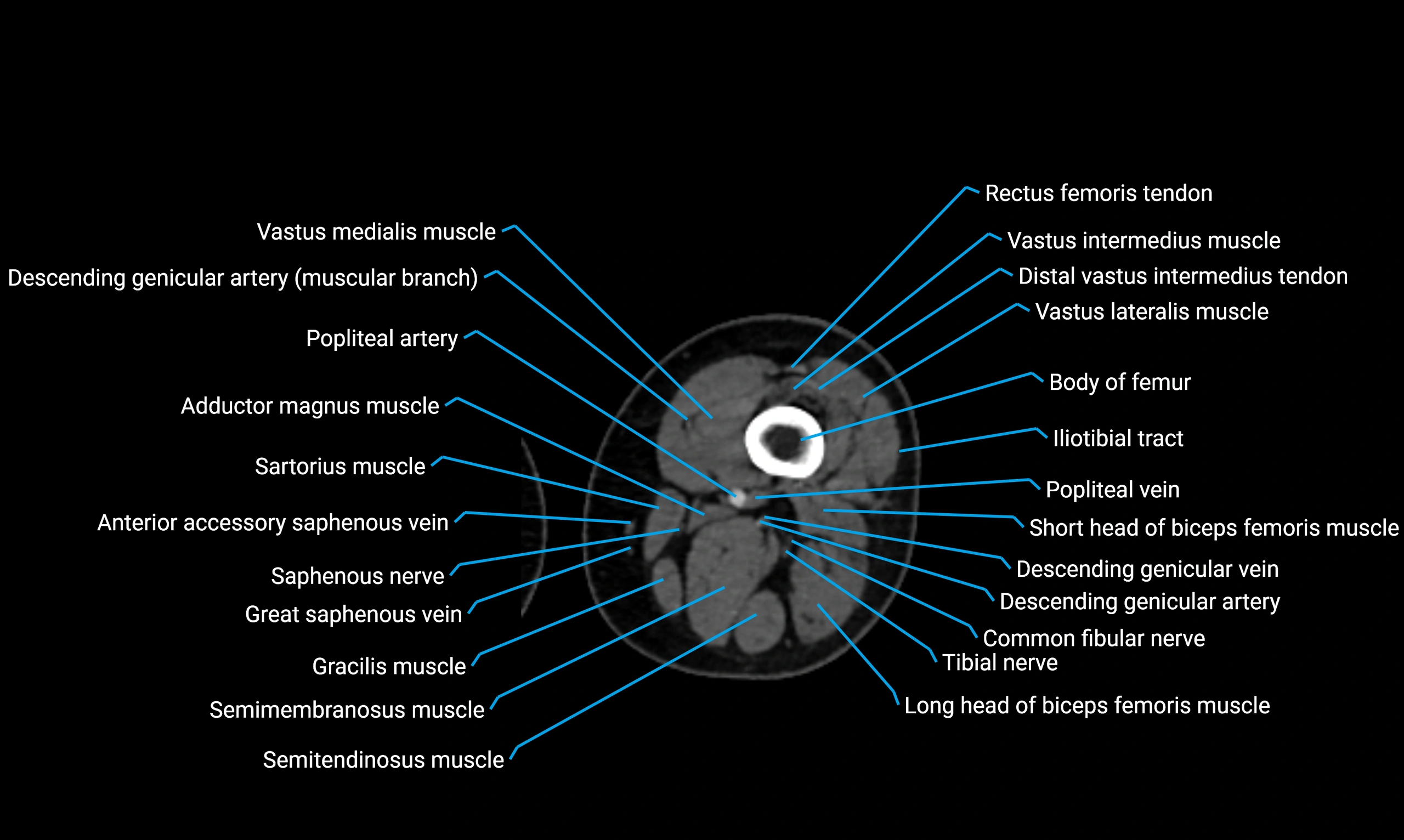 CT thigh axial cross sectional anatomy labelled image_65 (2).webp